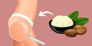 Does Shea Butter Help With Stretch Marks?