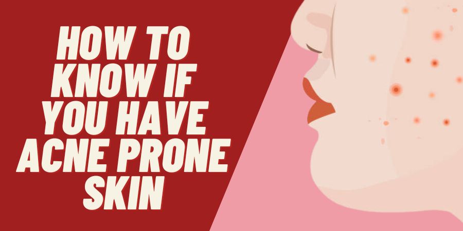How to Know if You Have Acne Prone Skin