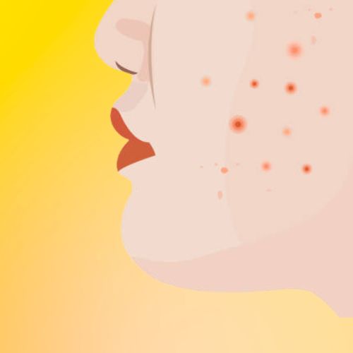 acne Scars